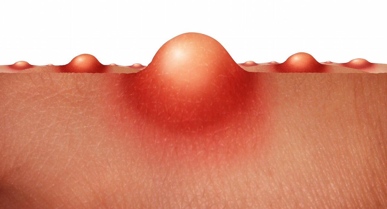 уплотнение под кожей на груди у мужчин фото 44