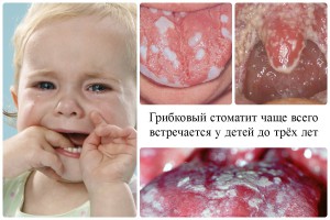 Папиллома во рту у ребенка фото