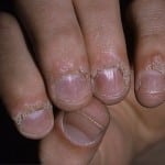 бородавки на пальце возле ногтя