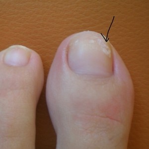 Что делать если появилось пятно на ногте большого пальца ноги