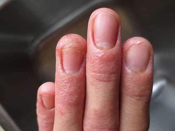 Признаки грибка ногтей